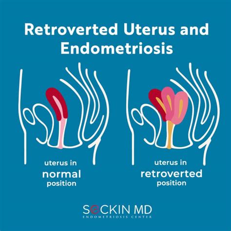 RETROVERTED UTERUS .